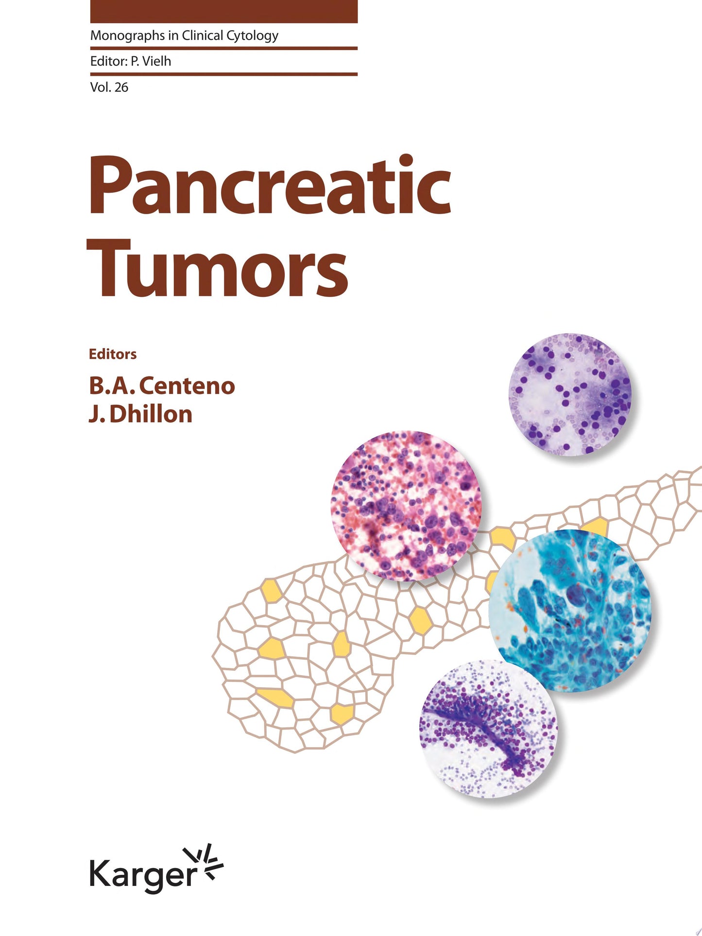 Pancreatic Tumors